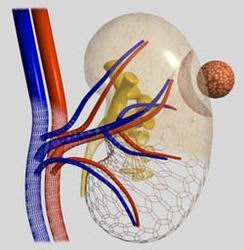 Cancerul renal - cancer la rinichi